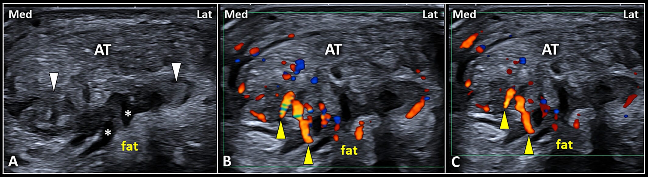 Bursa retrocalcanea 6 Tempo Formacion ecografia.jpg